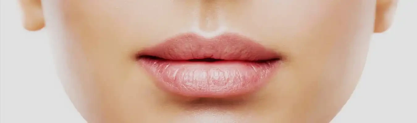 Lip Lift